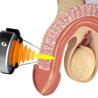 درمان زود انزالی و اختلال نعوظ با دستگاه شاک ویو