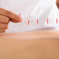 Dry Needling